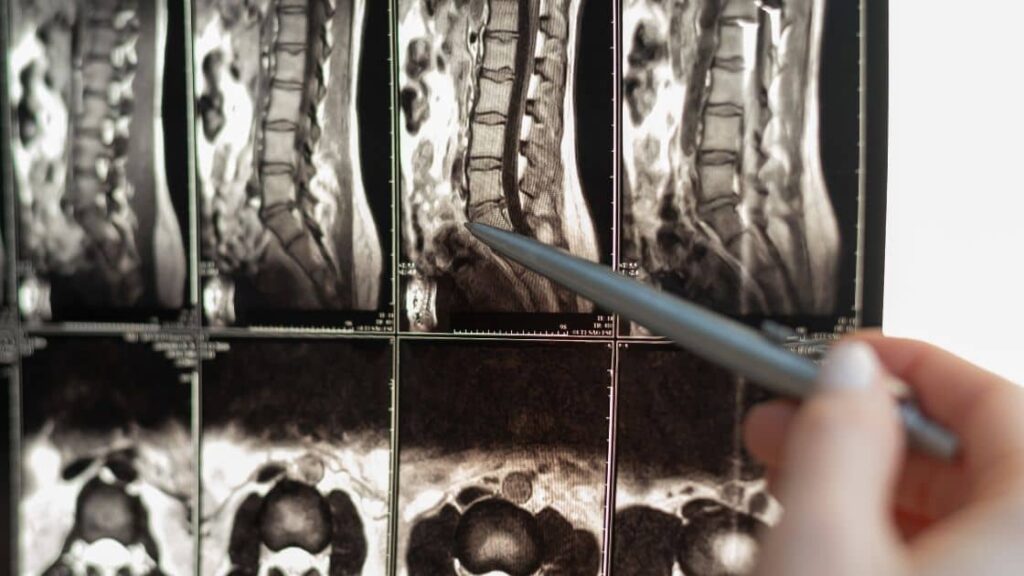 An X-ray showing spinal cord injuries