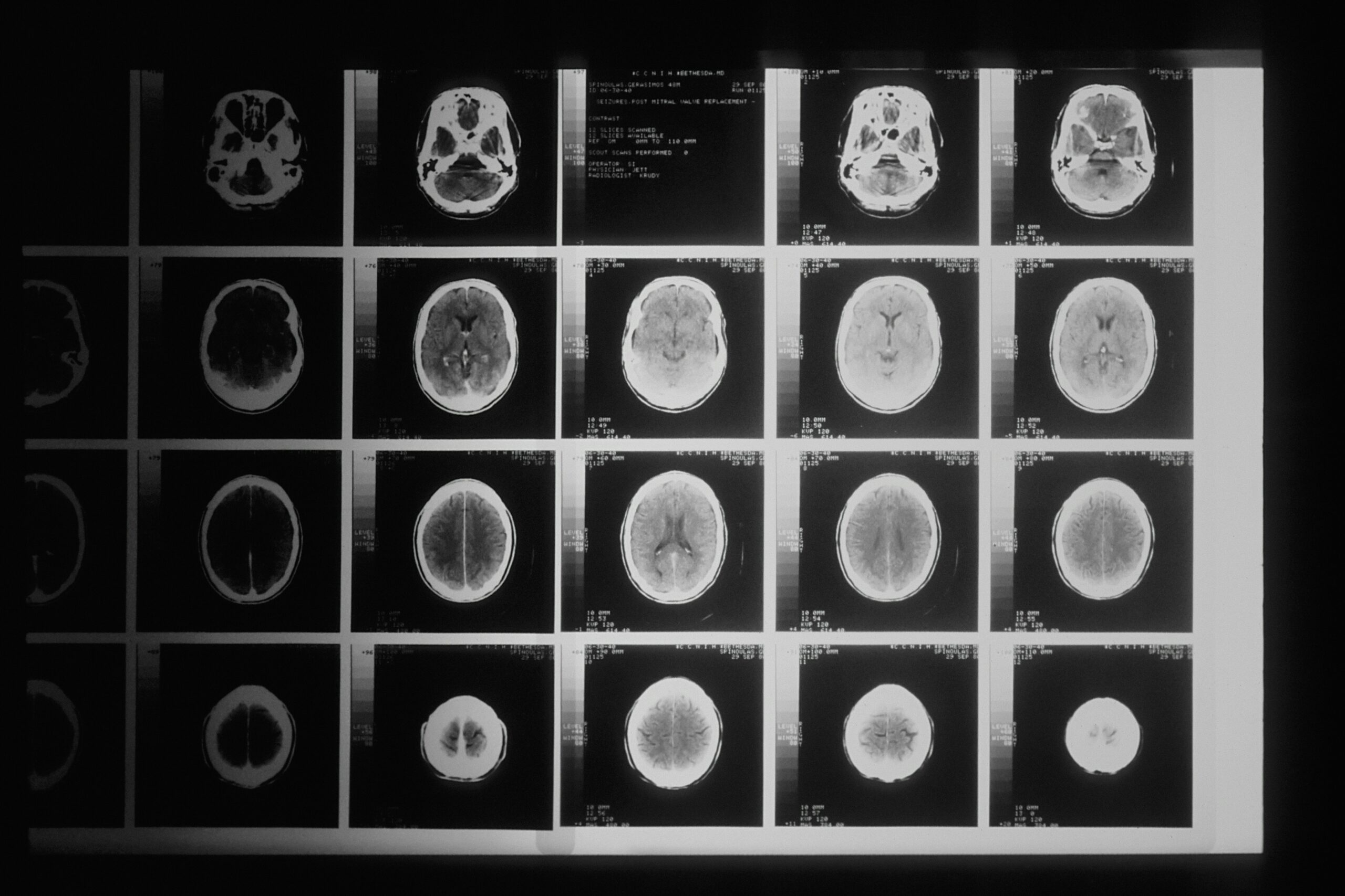 Understand the Brain Injury Compensation Process Today 5 a CT/X-ray scan shows different Types of Brain Injuries