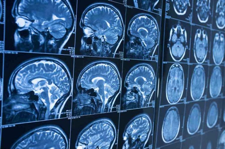 Brain Injury Lawyer